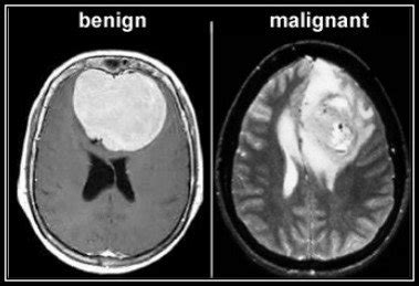 1: Benign Tumor  left  and Malignant Tumor  Right  [5 ...