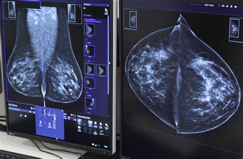1 de cada 8 mujeres en España tendrá cáncer de mama   HC ...