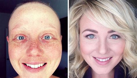 10 fotos de antes e depois de pessoas que venceram o câncer