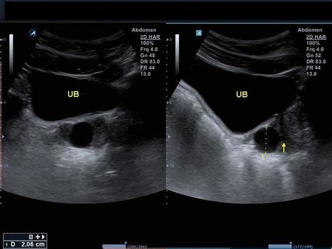 10+ mejores imágenes de Ultrasonido próstata en 2020 | ultrasonido ...