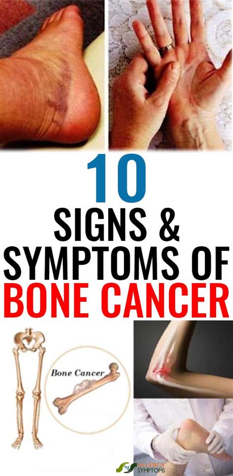 10 Signs And Symptoms Of Bone Cancer   Allergy Symptoms