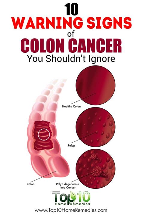 10 Signs of Colon Cancer | Beneficial   A Size Healthier ...