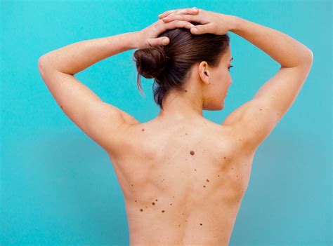 10 Signs of Skin Cancer You Shouldn t Ignore | SELF
