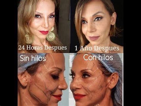 12 MONTHS AFTER #pdothreads #facialthreads HILOS TENSORES HILOS DE ...