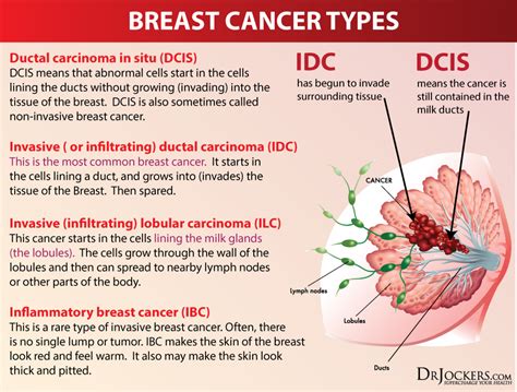 12 Natural Strategies to Prevent Breast Cancer   DrJockers.com