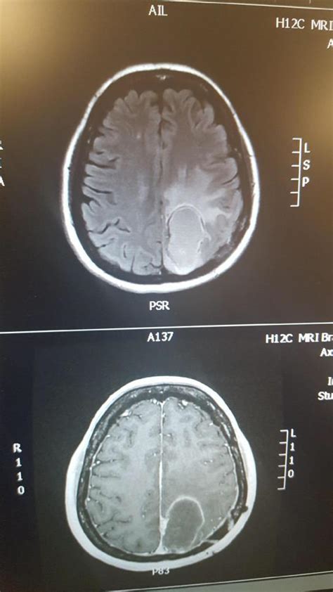 13 months ago I was diagnosed with terminal brain cancer ...