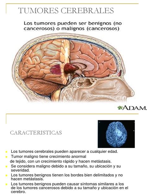 13 tumores cerebrales