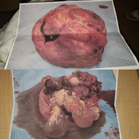 13lbs teratoma  credit to u/JessieS5300   I ve always found these ...