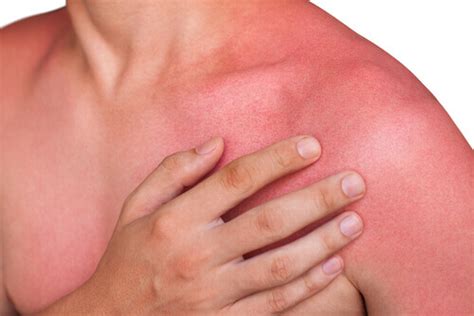 14 Bitter Sun Poisoning Symptoms