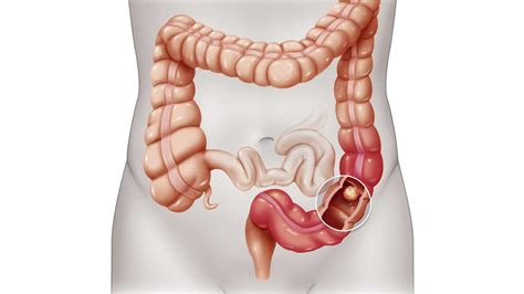 15 Warning Signs of Colon Cancer You Should Not Ignore