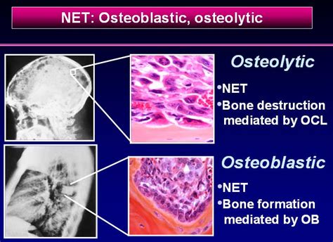 2.13. Carcinoid Bone metastasis   Osteolytic and ...