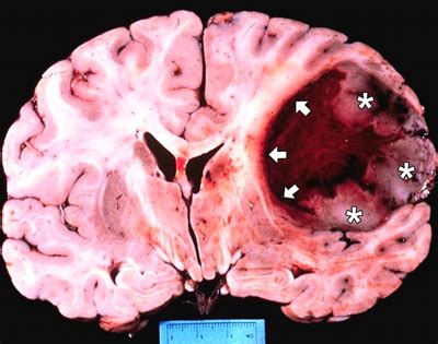 20% de tumores cerebrales son malignos | Universidad de ...