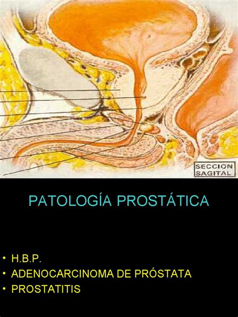 21 12 Patología de La Próstata | Neoplasias | Cáncer
