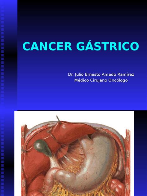 21 Cancer Gastrico | Gastroenterología | Abdomen