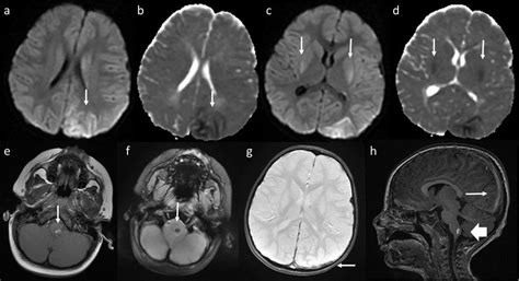 23 month old boy with left subdural hemorrhage and ...