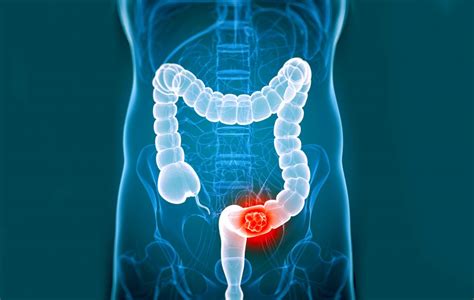 23 Signs And Symptoms Of Colorectal Cancer – Health News ...