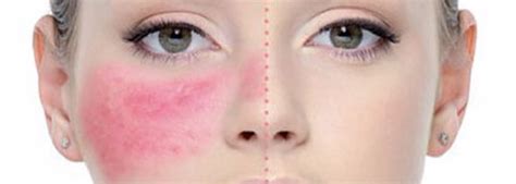 3 enfermedades de la piel en la cara más comunes   Blog   Información ...