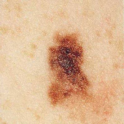 3 Types of Skin Cancer | LIVESTRONG.COM