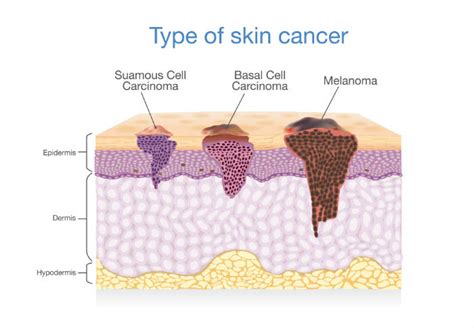 3 Types of Skin Cancer: Surprising Causes of Melanoma ...