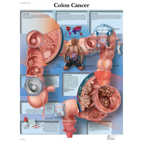 3B Scientific Colon Cancer Chart