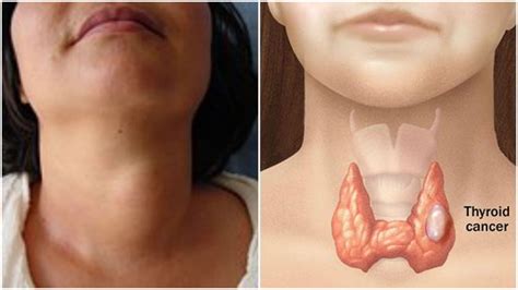4 signos del cancer de tiroides que usted debe conocer