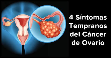 4 Síntomas Tempranos del Cáncer de Ovario Que Debes Conocer