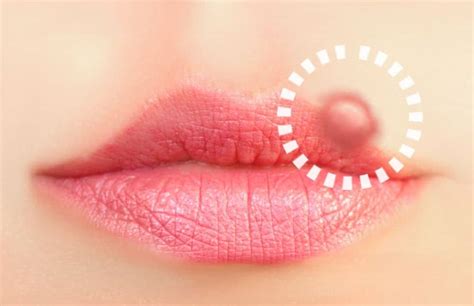 5 Common STDs of the Mouth