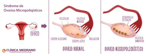 5 cosas que deberías saber sobre los ovarios poliquísticos ...