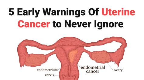 5 Early Warnings Of Uterine Cancer to Never Ignore