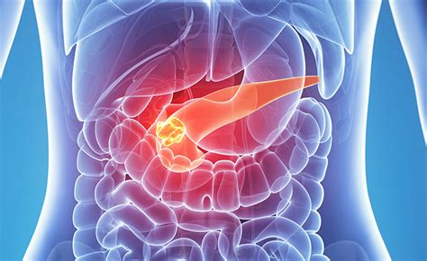 5 Key Facts about Pancreatic Neuroendocrine Tumors ...