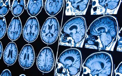 5 síntomas de tumor cerebral » MD.Saúde