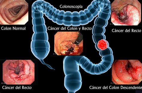 5 síntomas tempranos de cáncer de colon que debes conocer ...