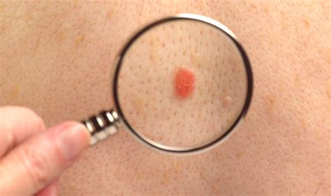 5 Skin Cancer Symptoms You Need to Know This Summer ...