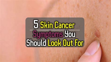 5 Skin Cancer Symptoms You Should Look Out For   YouTube