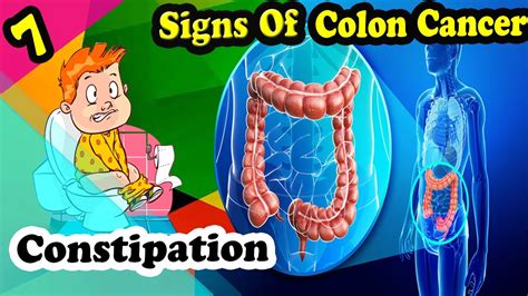 6 Common Symptoms of Colon Cancer   YouTube