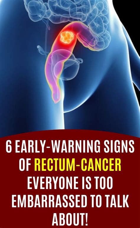 6 early warning signs of rectum cancer everyone is too ...