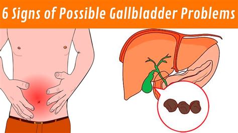 6 Signs and Symptoms of Possible Gallbladder Problems ...