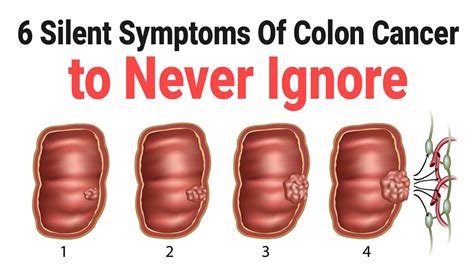 6 Silent Symptoms Of Colon Cancer to Never Ignore   m09c