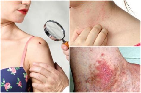 6 sintomas de câncer de pele que você não deve ignorar ...