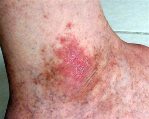 6 Skin Cancer Symptoms You Should Not Ignore   Step to Health