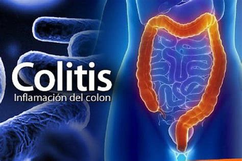 6 tratamientos naturales para combatir la colitis | La colitis ...