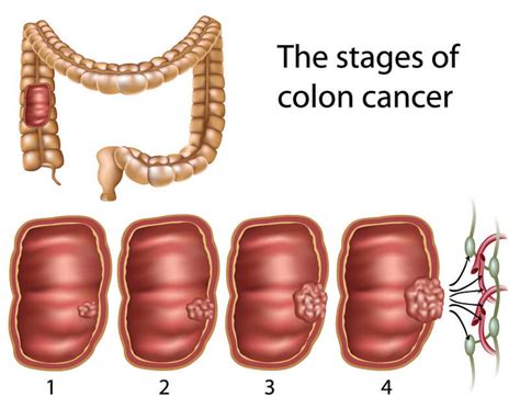 7 Signs of Colon Cancer   Know What to Look For