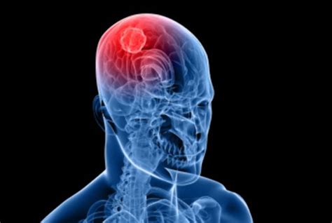 7 sinais de um tumor cerebral   Saúde Melhor