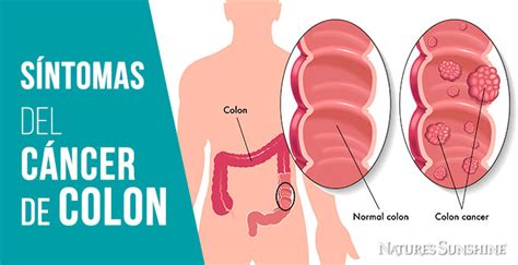 7 síntomas del cáncer de colon en las mujeres que nunca ...
