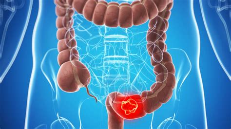 7 síntomas del cáncer de colon — Saludable