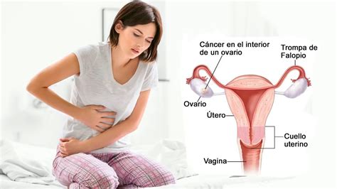 7 Síntomas que te alertan del cáncer de ovario   YouTube