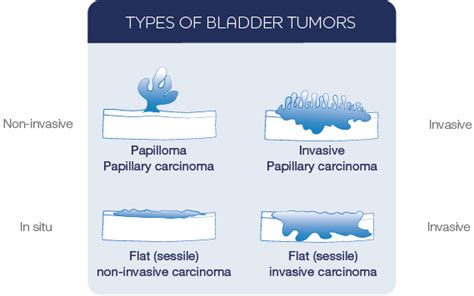 7 Things You Didn’t Know about Bladder Cancer – OutcomeGenesis