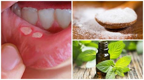 7 tratamientos caseros para las llagas de la boca   Mejor con Salud