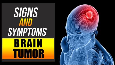 7 Warning Signs and Symptoms of a Brain Tumor You Should ...