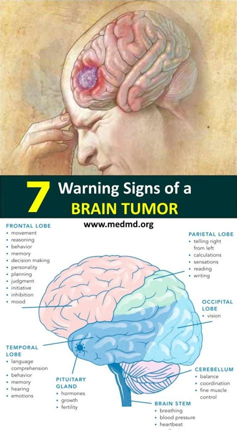 7 Warning Signs of a Brain Tumor | Brain tumor, Brain ...